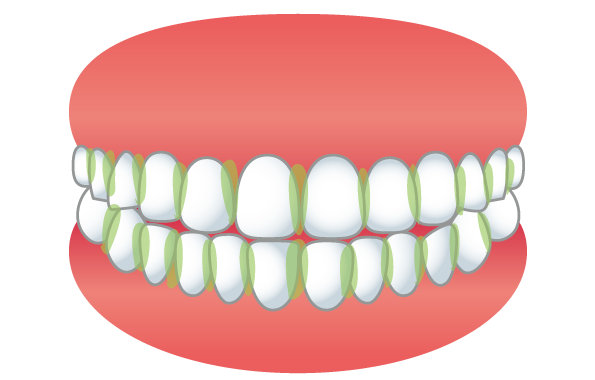 正しい歯磨きで虫歯 歯周病予防 私が歯医者に褒められるようになった歯磨きの方法 Wryoku